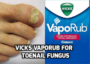 Vicks Vaporub for Toenail Fungus