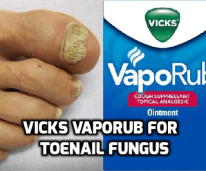  Vicks VapoRub for Toenail Fungus