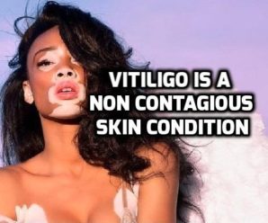  Is Vitiligo (Leucoderma) a contagious (communicable) Skin disease?