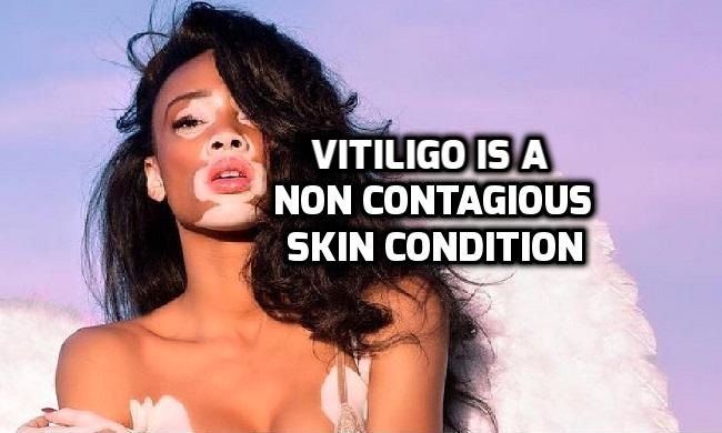 Is Vitiligo (leucoderma) contagious (communicable) skin disease
