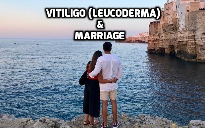 Vitiligo Leucoderma Marriage Matrimony