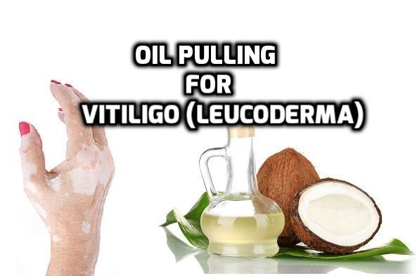 Oil pulling vitiligo leucoderma