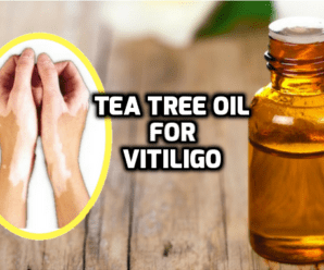  Does Tea Tree oil help with Vitiligo