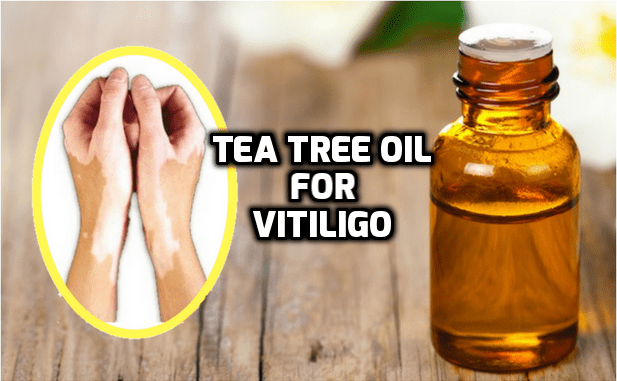Tea tree oil vitiligo white spots skin leucoderma