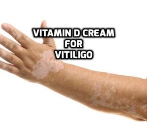  Does Vitamin D cream help with Vitiligo?