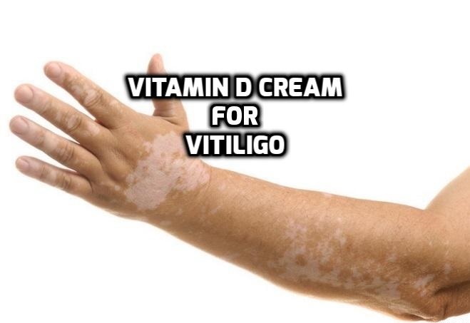 Topical Vitamin D cream vitiligo treatment