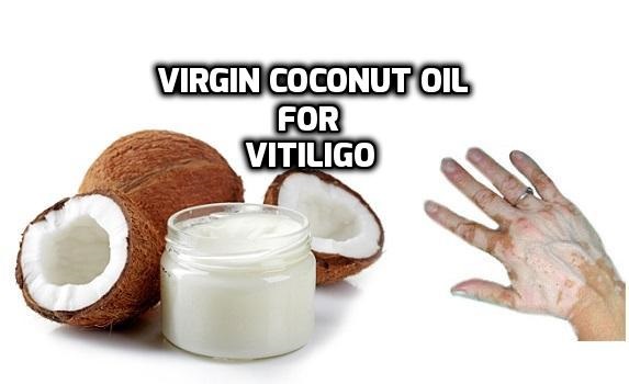 Virgin coconut oil Vitiligo Leucoderma treatment