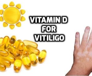  Does Vitamin D help with Vitiligo