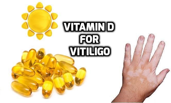 Vitamin D3 Vitiligo Leucoderma Treatment