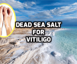  Does Dead Sea Salt help with Vitiligo