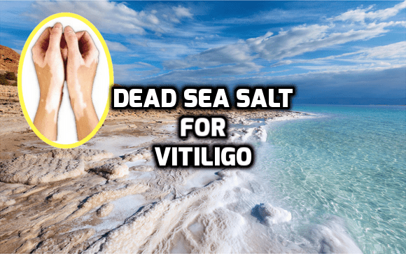 Dead Sea salt vitiligo leucoderma treatment