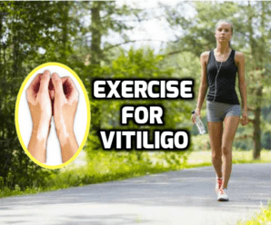  Moderate Exercise and Physical Workout is good for Vitiligo