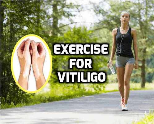exercise physical workout gym vitiligo leucoderma