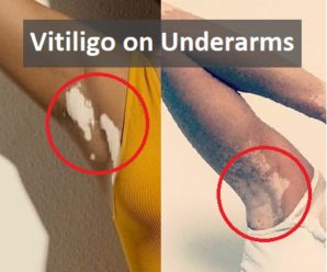  Vitiligo on Underarms (Armpits)- Preventive measures and Precautions