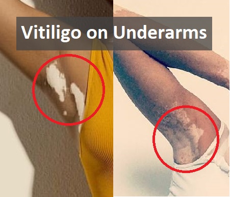 Vitiligo Leucoderma Underarms Armpits