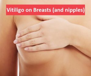  Vitiligo on Breasts (and Nipples)- An Overview
