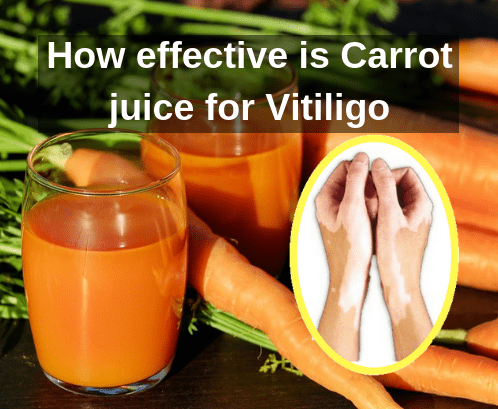 Carrot Vegetable Juice Vitiligo Leucoderma