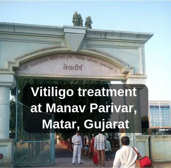 Manav Parivar Matar Gujarat Vitiligo treatment