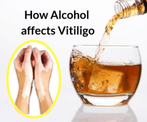  Vitiligo and Alcohol : All you need to know