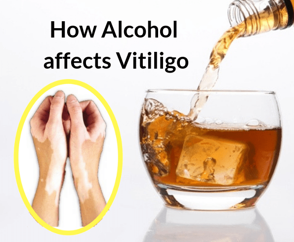 Vitiligo Alcohol