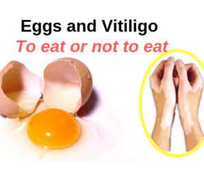  Vitiligo and Eggs : To eat or not to eat