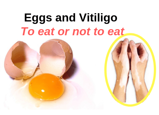 Vitiligo Leucoderma Eggs Animal protein