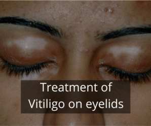  Vitiligo on Eyelids – Treatment options