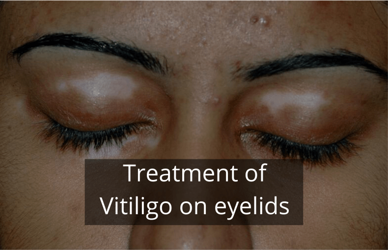 Vitiligo on eyelids Treatment