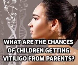  What are the chances of children getting vitiligo from parents?